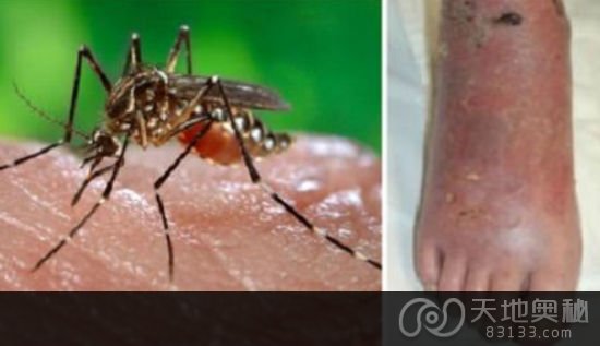 韩国研究表明被蚊虫叮咬后涂唾液可致皮肤炎症(网页截图)