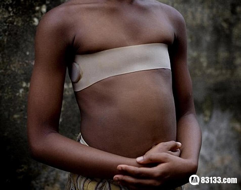 奇葩的非洲“烫乳礼”只为防女孩被性侵