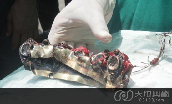 医生从一名在以色列轰炸中被击中的巴勒斯坦女孩体内取出20厘米长的碎片。（半岛电视台）