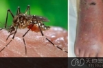 韩国研究发现被蚊虫叮咬后涂唾液可致皮肤炎症