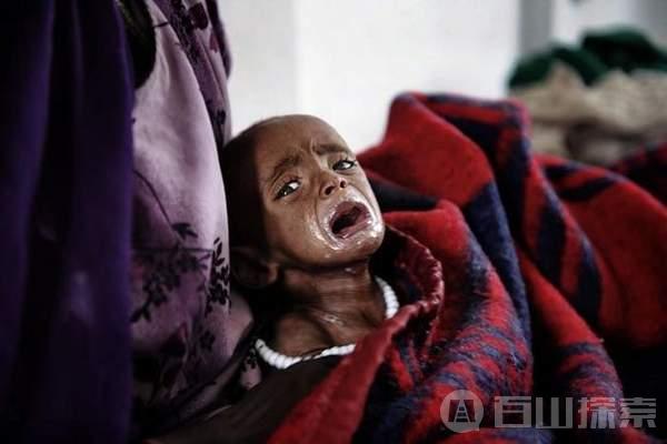 埃塞俄比亚的饥荒中的孩童