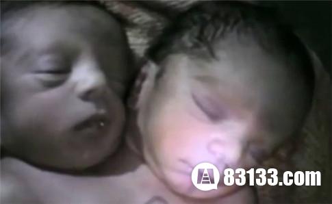 印度女产双头婴儿